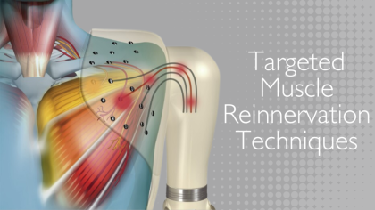 Enhancing Prosthetic Functionality with Advanced Targeted Muscle Reinnervation (TMR) Techniques