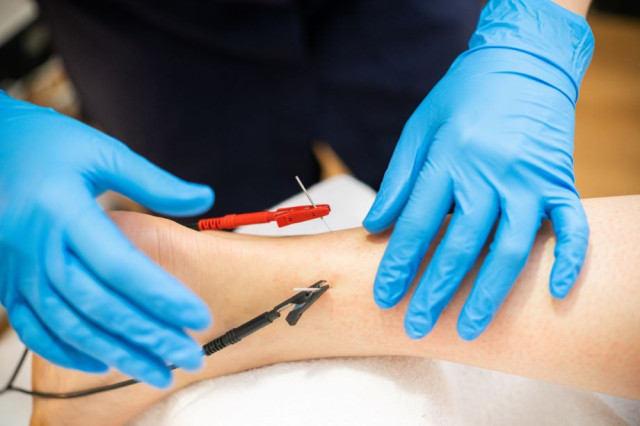 What You Need To Know About Dry Needling With Electrical Stimulation Orthopedic Blog