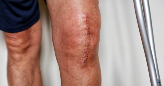 patient with recent knee replacement surgery