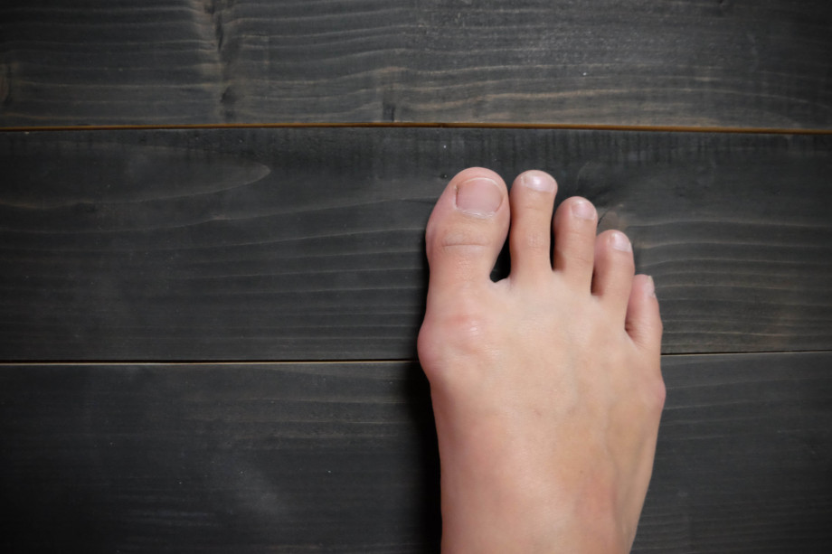 minimally-invasive-surgery-for-bunions-what-to-know-orthopedic-blog