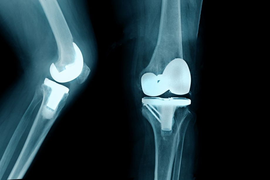 partial knee replacement recovery time
