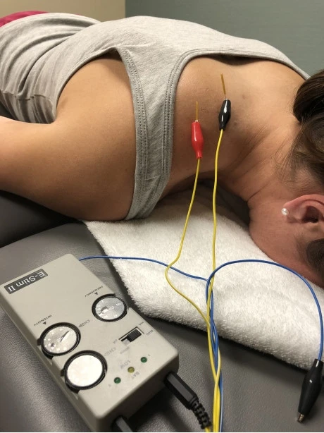 6 Things to Know About Dry Needling
