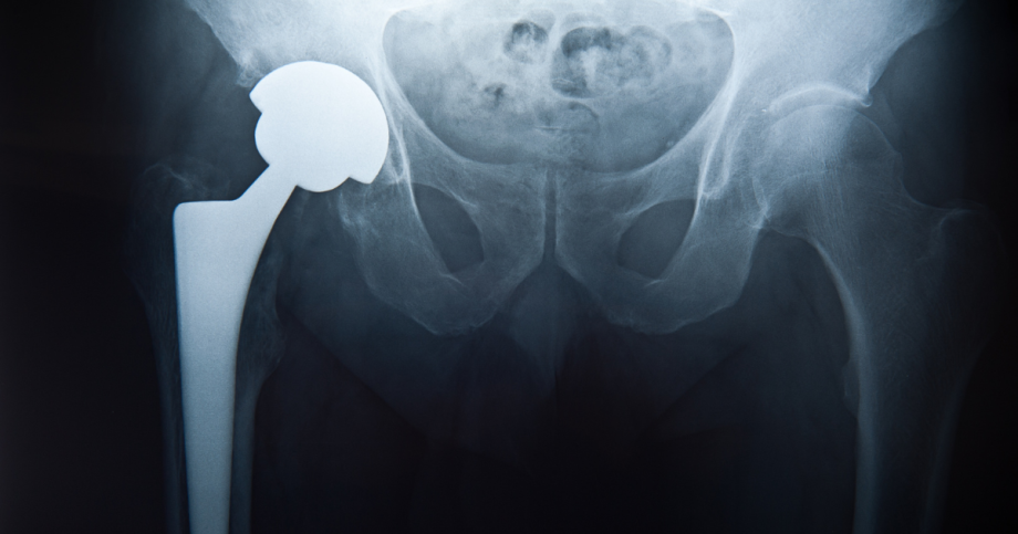 X ray of hip joint replacement